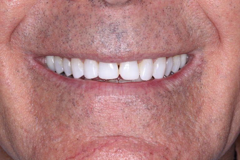 B Smith Before