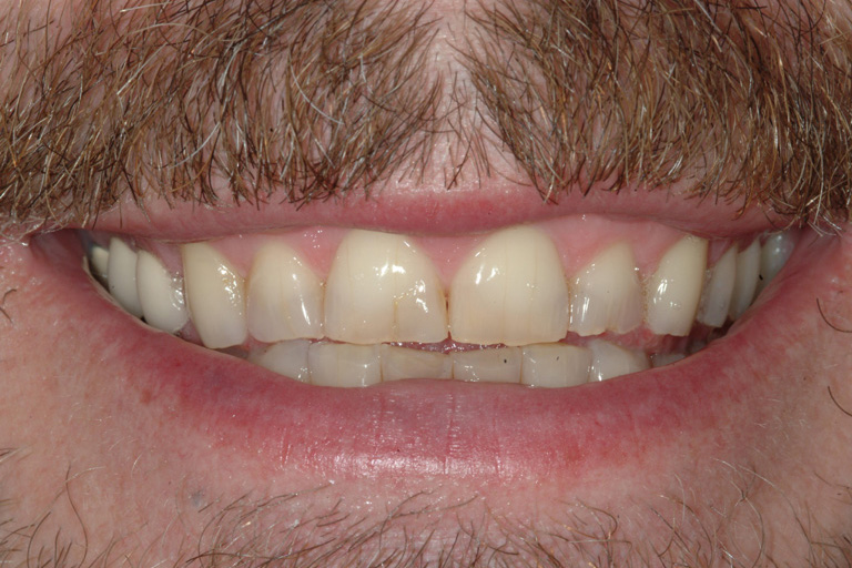 J Potter Before